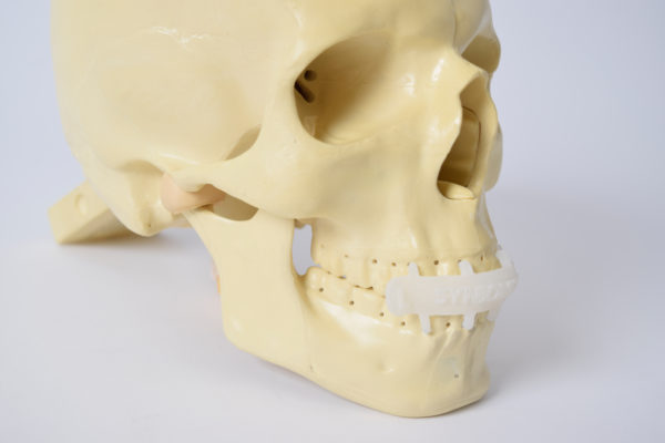 Cerclage Wiring alternative clip Cerclage Wiring alternative clip