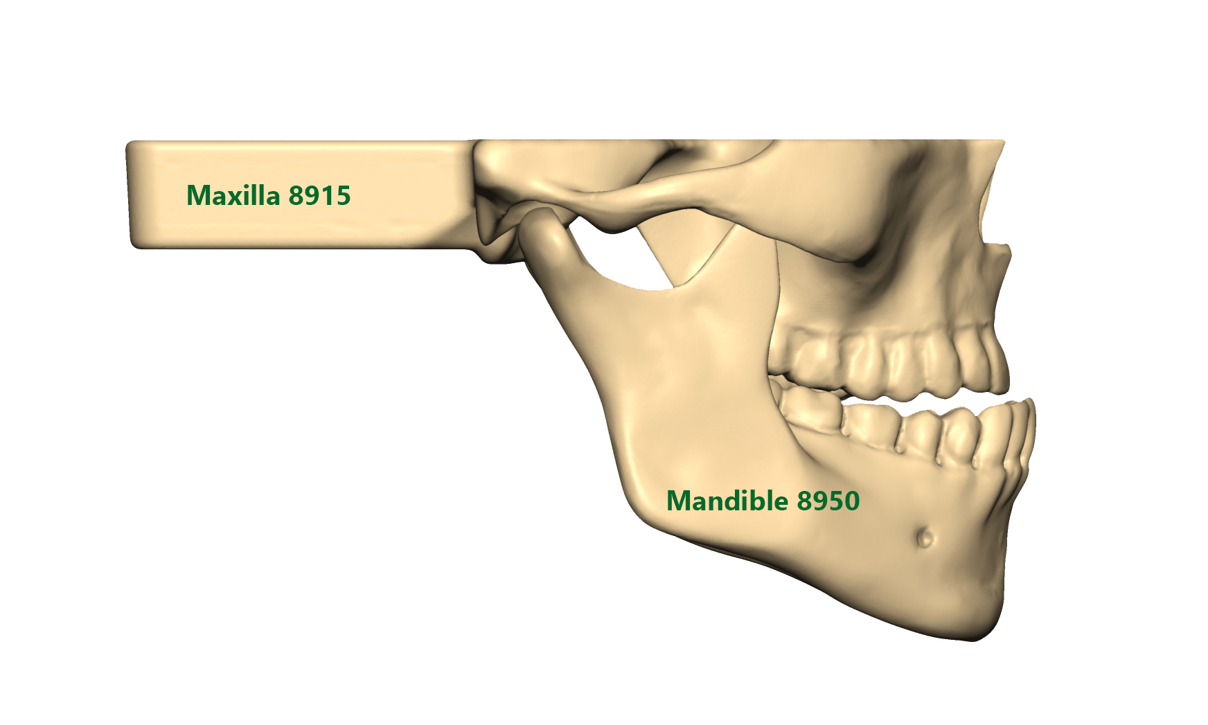 Maxilla underbite_beschriftet Underbite situation