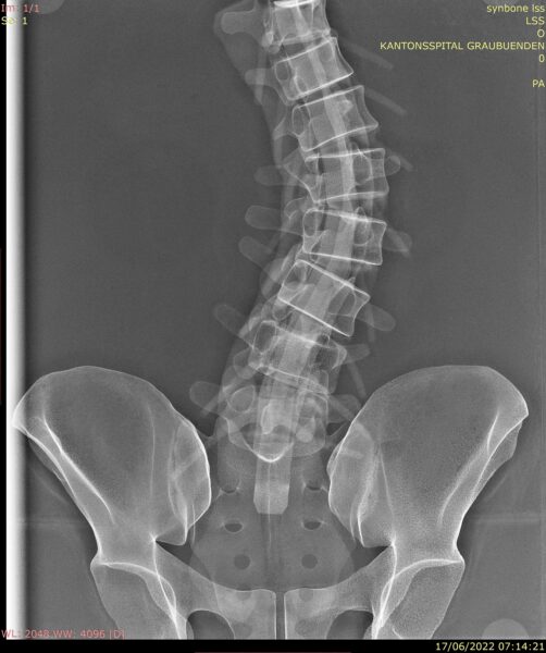 LSS9361.FI Posterior-Anterior CT Scan of Lumbar Spine Torso Posterior view